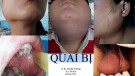 Bài giảng Quai bị - TS. BS Hoàng Trường
