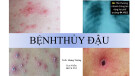 Bài giảng Bệnh thủy đậu - TS. BS. Hoàng Trường